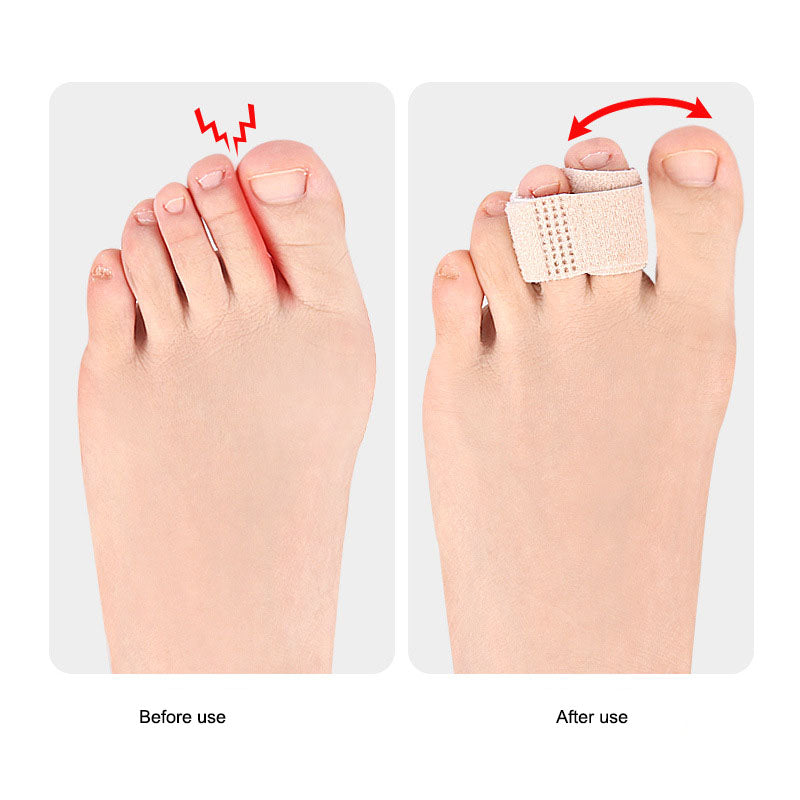 Toe overlap, thumb eversion, day and night use of male and female finger separation device